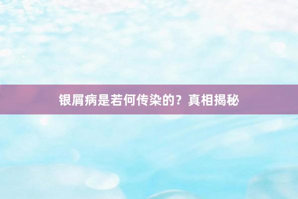 银屑病是若何传染的?真相揭秘
